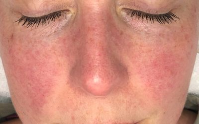 Does Skin Needling (Microneedling) help with Rosacea?