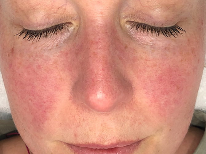 Does Skin Needling (Microneedling) help with Rosacea?