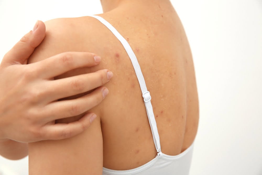 Back Acne: What Causes It & How To Get Rid Of It