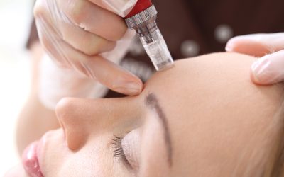 How Many Skin-Needling Treatments Do You Really Need for Acne Scars? (A Berwick Skin Clinic’s Guide)