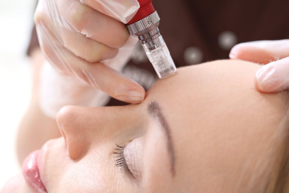 How Many Skin-Needling Treatments Do You Really Need for Acne Scars? (A Berwick Skin Clinic’s Guide)