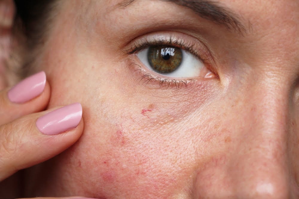 How do I get rid of my Spider Veins