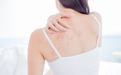 How to Treat and Prevent Eczema in Winter