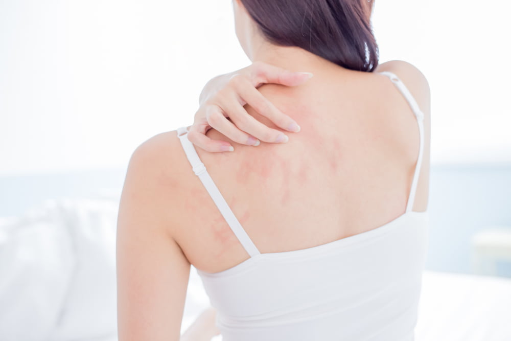 How to Treat and Prevent Eczema in Winter