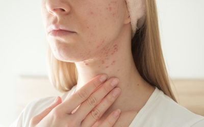 Preventing and Treating Cystic Acne