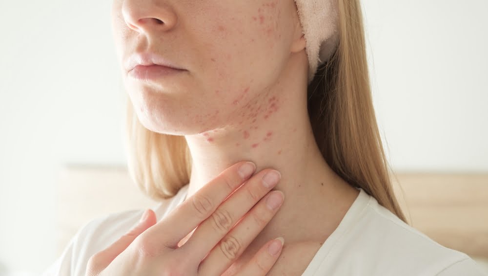 Preventing and Treating Cystic Acne