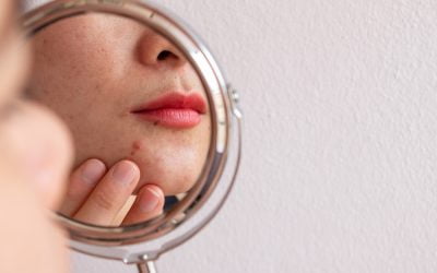 Effective Solutions for Acne: Your Path to Clear Skin