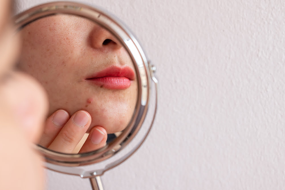 Effective Solutions for Acne: Your Path to Clear Skin