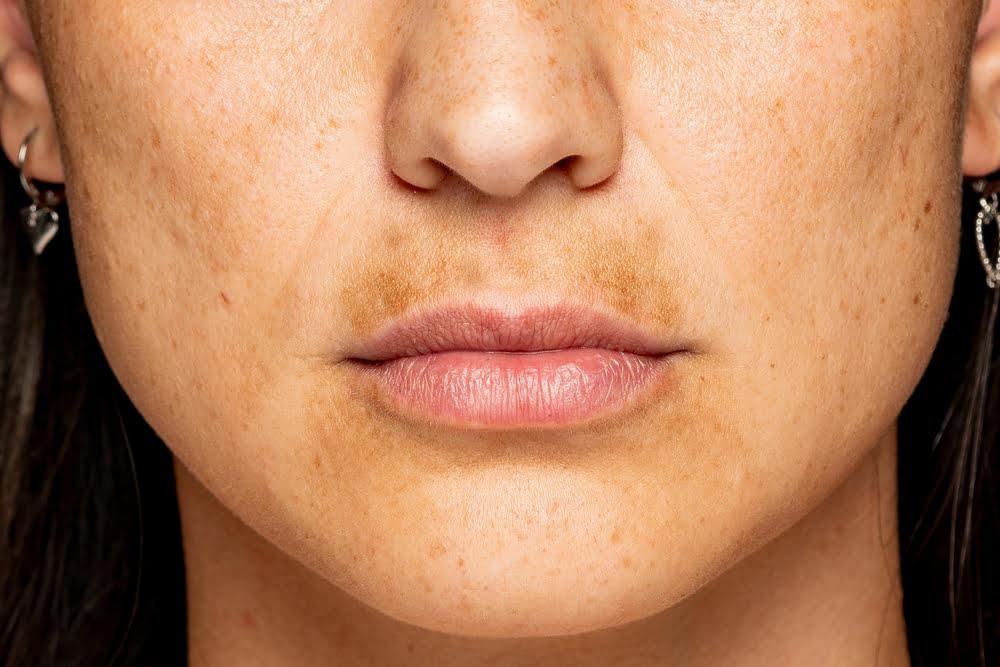 How To Get Rid Of Skin Pigmentation