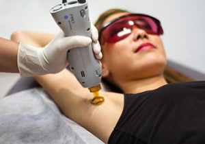 Laser hair removal