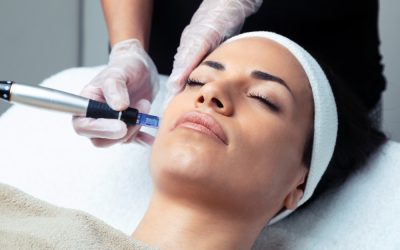 What is skin needling?