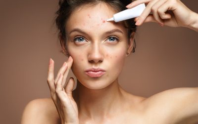 Treating Acne