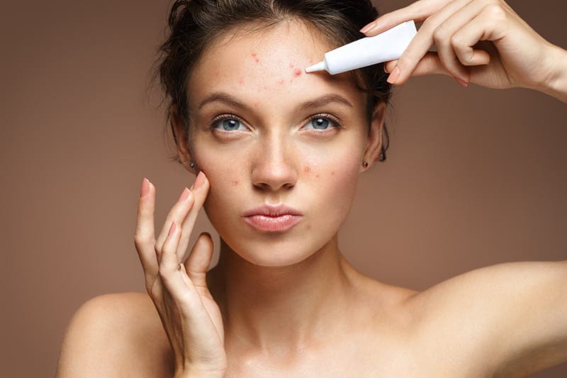 Treating Acne