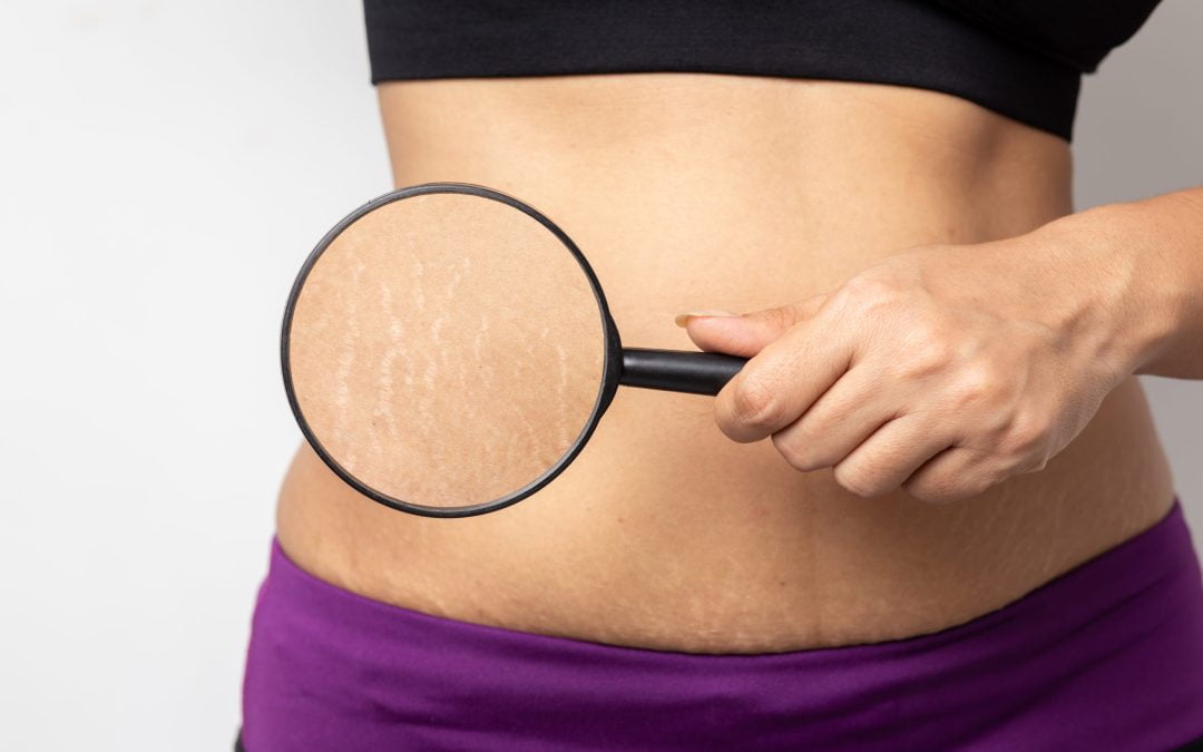 Everything you need to know about Stretch Marks