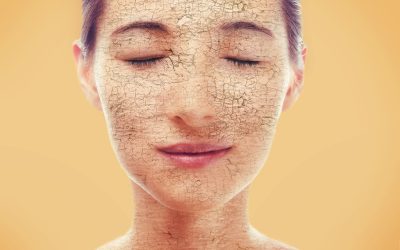 5 Tips for Treating Dry Skin