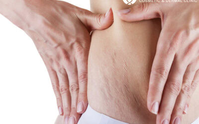 Stretch mark treatments are available – Don’t hide your skin!