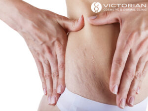 stretch_mark_cure