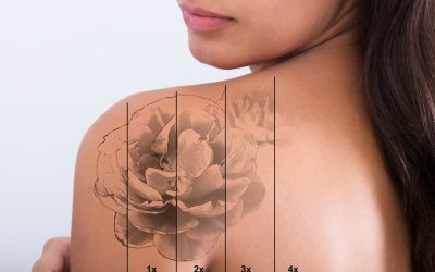 How Does Laser Tattoo Removal Work?