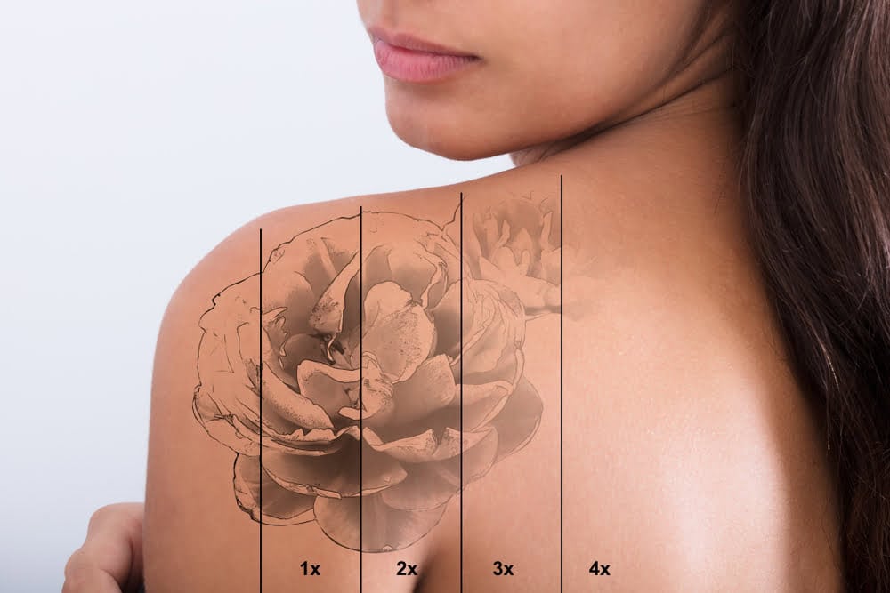 How Does Laser Tattoo Removal Work?