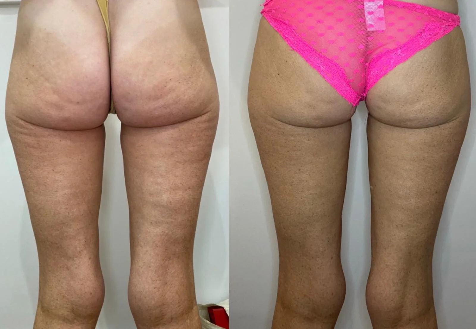 Cellulite Treatment