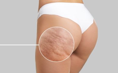 VelaShape in Berwick: A Science-Backed Way to Smooth Cellulite & Refine Contours