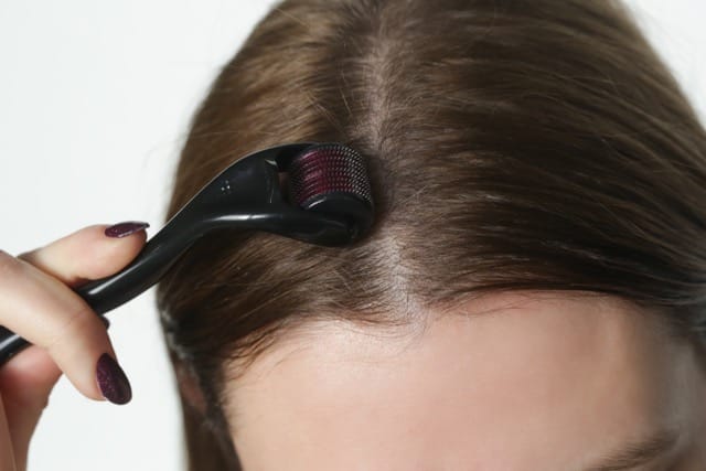 Skin Needling for Hair Loss — Does It Really Work? A Complete Guide for Anyone Struggling With Thinning Hair