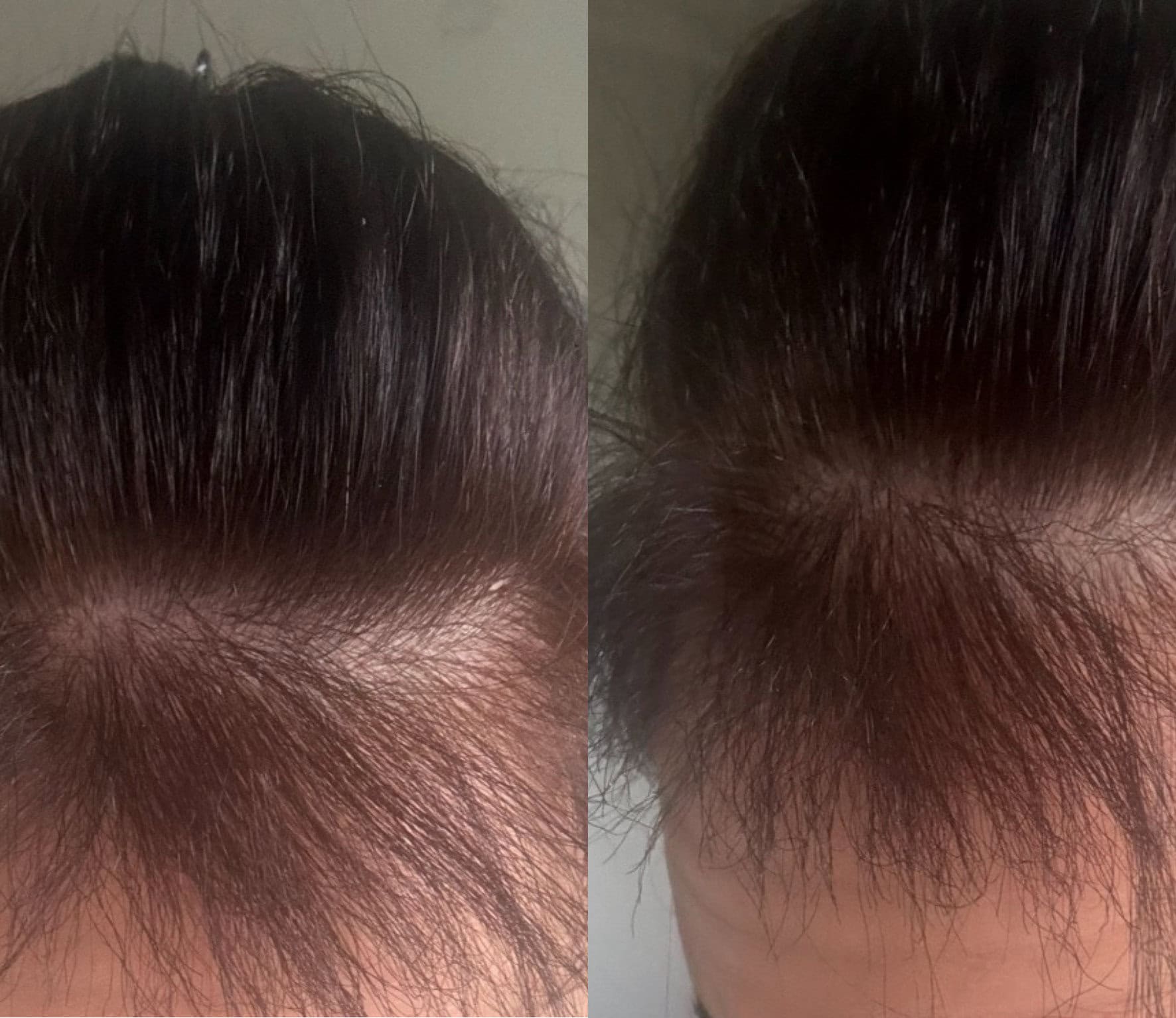 Hair thinning before&after