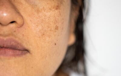 Why Pigmentation Looks Worse After Summer (And What You Can Do About It)