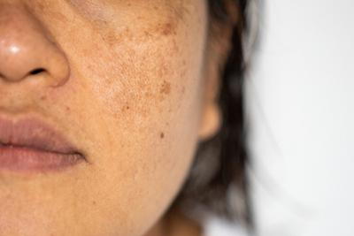 Why Pigmentation Looks Worse After Summer (And What You Can Do About It)