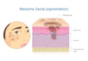 Pigmentation3